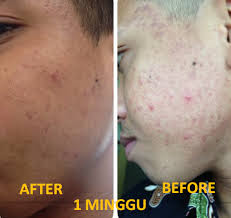 sabun-jerawat-yang-bagus-untuk-pria-repellent-acne-RA