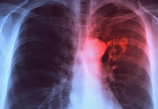 Penyakit Tuberculosis (TBC) Dan Cara Mengobatinya