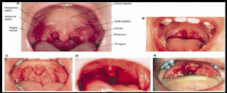 First Signs Of Throat Cancer Pictures