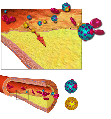 ateroscleroza