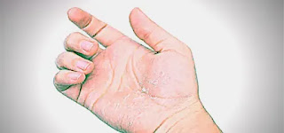Hands with Peeling Skin on Fingers