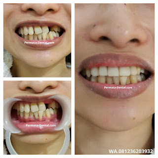 Gambar gigi yang akan memakai gigi crown di permata dental  bali| pasang gigi palsu crown cepat di permata dental  bali | pasang gigi palsu crown bagus di permata dental  bali | pasang gigi palsu crown murah di permata dental  bali | pasang gigi palsu crown aman di permata dental  bali | pasang gigi palsu crown geraham di permata dental  bali | pasang gigi palsu crown mudah di permata dental  bali | pasang gigi palsu crown permanen |harga  pasang gigi palsu crown di permata dental  bali | pasang gigi palsu crown di ahli gigi  permata dental  bali | pasang gigi palsu crown depan di permata dental  bali | pasang crown pada gigi di permata dental  bali | trend foto gambar gigi palsu crown | pasang gigi palsu crown promo di permata dental  bali | pasang gigi Crown 2017 | cara pasang gigi crown di permata dental  bali | sebelum dan sesudah pasang gigi palsu crown di permata dental  bali | pasang gigi palsu permanen bali | pasang gigi palsu permanen banyuwangi | pasang gigi palsu permanen nusa dua | pasang gigi palsu permanen jimbaran | pasang gigi palsu permanen kute | pasang gigi palsu permanen denpasar | pasang gigi palsu permanen badung | pasang gigi palsu permanen denpasar | pasang gigi palsu permanen  singaraja | pasang gigi palsu permanen  balung | pasang gigi palsu permanen murah |  pasang gigi palsu permanen mudah | pasang gigi palsu permanen  cepat | pasang gigi palsu permanen bagus | pasang gigi palsu permanen geraham | pasang gigi palsu permanen depan | pasang gigi palsu bawah | pasang gigi palsu atas | pasang gigi palsu baik| pasang gigi palsu dewasa |