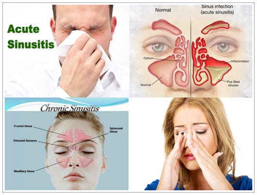 Pengobatan Herbal Sinusitis Akut Dan Kronis Tanpa Operasi