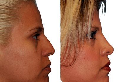 Rhinoplasty Before After