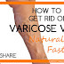 Homeopathic Remedies For Varicose Veins at Home Treatment