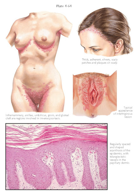 INVERSE PSORIASIS AND PSORIASIS IN THE GENITAL AREA