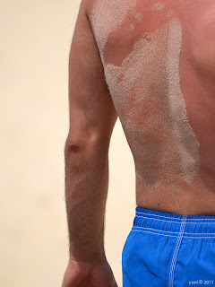 sandy skin