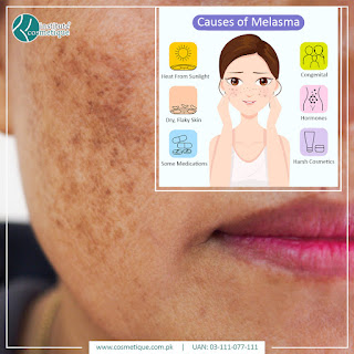 best melasma treatment in Lahore