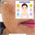 Exceptional Melasma Treatment in Lahore, Pakistan | Cosmetique Clinic