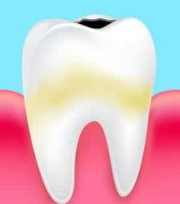 Stages of tooth decay  - Preventive measures to prevent tooth decay