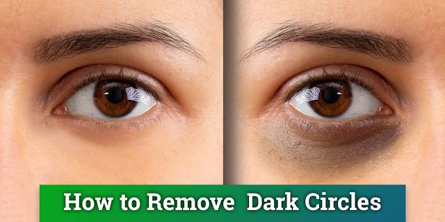 How to treat dark circles?