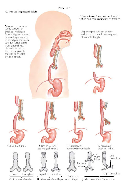 Tracheoesophageal Fistulas and Tracheal Anomalies