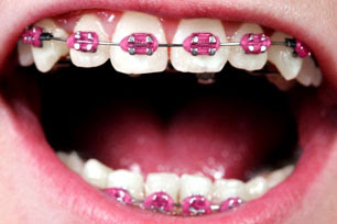 kawat gigi pink