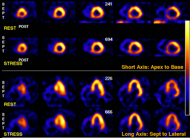 Nuclear Cardiology case