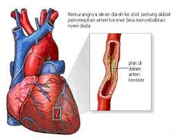 Cara Alami Mengobati Penyakit Jantung