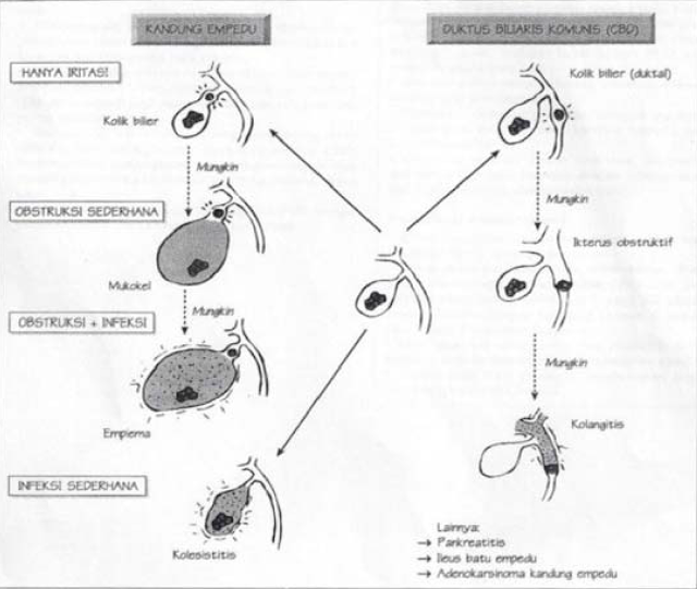 Komplikasi kolelitiasis, predileksi batu empedu, letak, posisi, ukuran, koledokolitiasis, empiema, sepsis, infeksi, kolik bilier, iritasi, radang, pankreatitis, ileus, adenokarsinoma