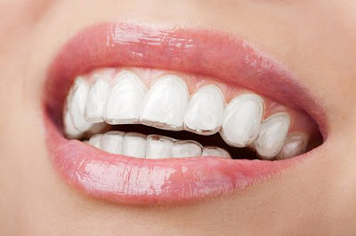 Tìm hiểu ưu điểm của niềng răng không mắc cài