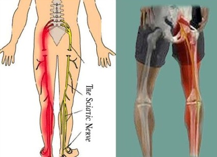 An image of sciatica/what it affects
