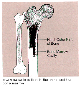 Bone Cancer - symptoms and warning signs