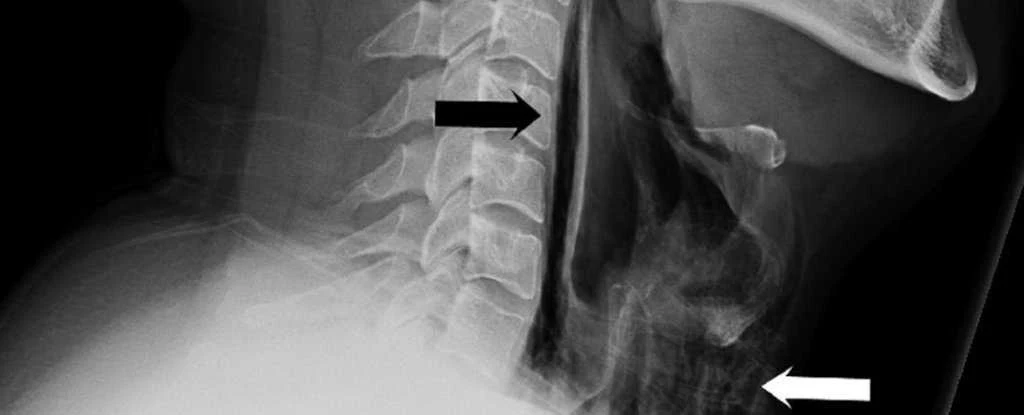 Trying not to sneeze can lead to a rupture of the pharynx (1)