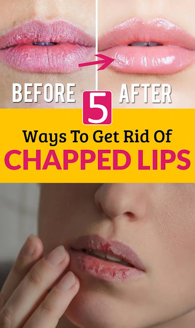 Top 5 Tips On How To Get Rid Of Chapped Lips