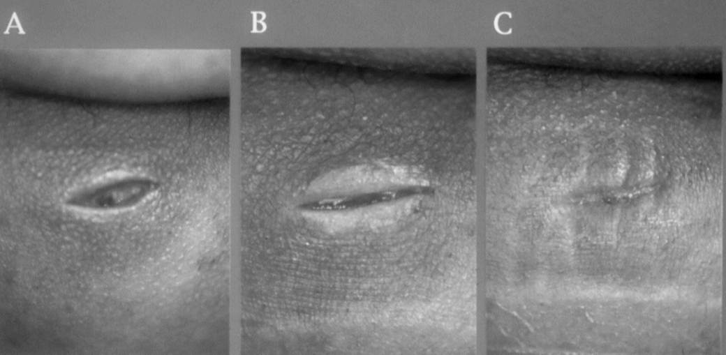 retention cysts or sebaceous cysts. infected epidermal cyst