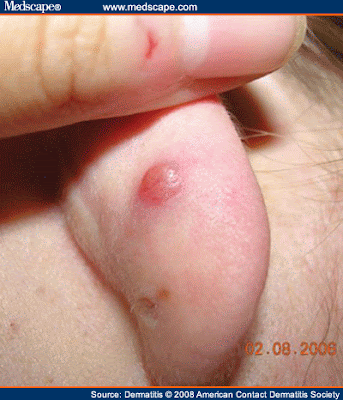 Allergic Reaction to Ear Piercing Allergic Reaction to Ear Piercing
