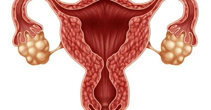 what is Ovarian Cysts?