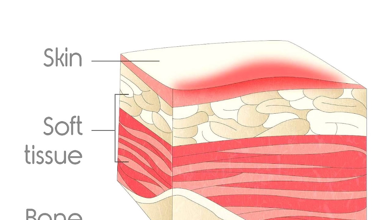 Stage 1 Pressure Ulcer Pictures