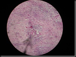 TB granuloma high resolution histology slide tsnaps