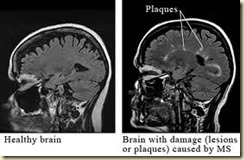 Brain with MS