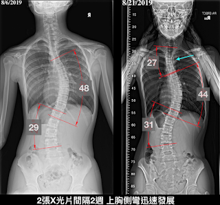 脊椎側彎、脊椎側馬矯正、脊椎側彎運動、脊椎側彎治療