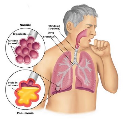 What Is Pneumonia and How Do You Get It