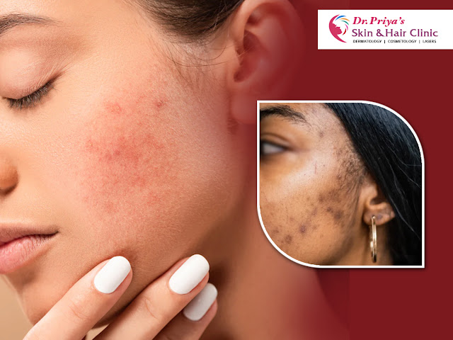 Best Acne Scars Treatment In Bangalore
