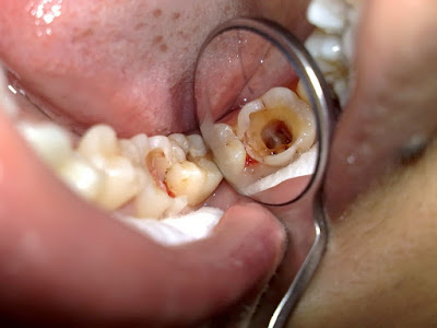 Răng bị sâu có nên nhổ không?