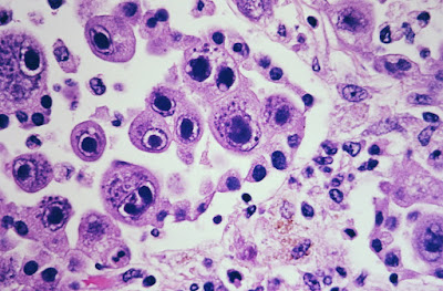 cytomegalovirus infection