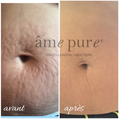 Le traitement Intensive Stretch Marks Eraser™ âme pure® sur www.amepure.com