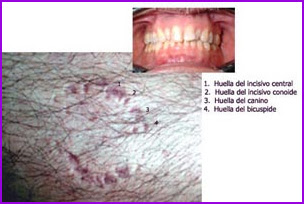<img src="mordedura-humana.jpg"       width="304"       height="204"       border="0"       alt="Mordedura humana con huella dental visible en la piel.">