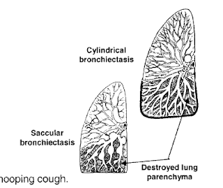 sites-of-bronchiectasis