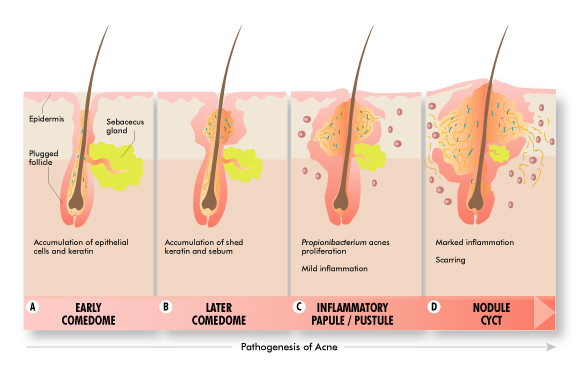 ชนิดและประเภทของสิวต่างๆบนใบหน้า Types of acne