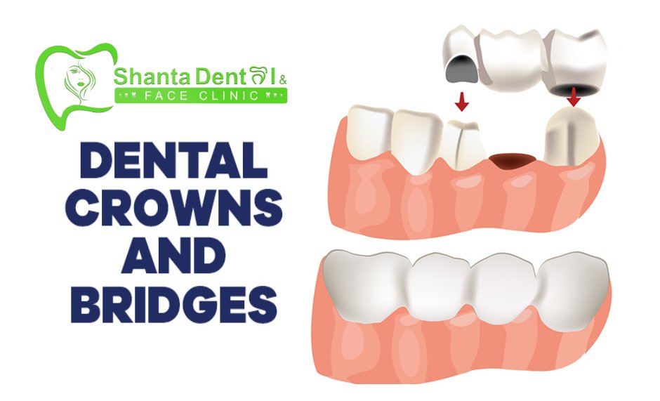 Crown and Bridges at Shanta Dental - Best Dental Clinic in Surkhet