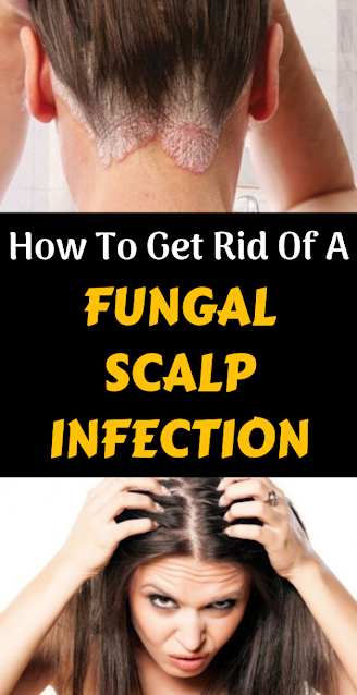 How To Get Rid Of A Fungal Scalp Infection
