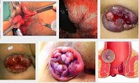 Cara Menyembuhkan Wasir/Ambeien Yang Sudah Lama Kronis