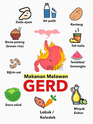 Apa Itu GERD? Macam Mana Mengatasinya?