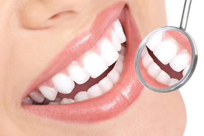 Tẩy trắng răng có hại cho sức khỏe không? Tìm hiểu ngay 2
