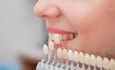 Quy trình tẩy trắng răng an toàn tại nha khoa
