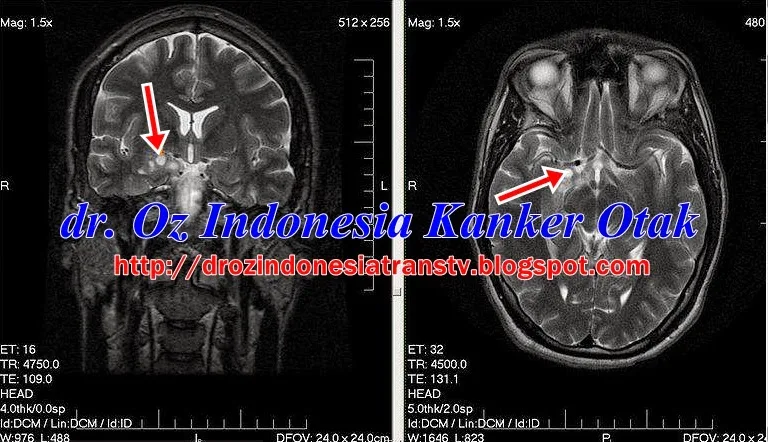 DR OZ Gejala Kanker Otak , Penyebab, Ciri Kanker Otak 