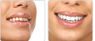 West Haven and Milford CT teeth whitening