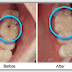 Cách hàn răng sâu như thế nào là đảm bảo ?