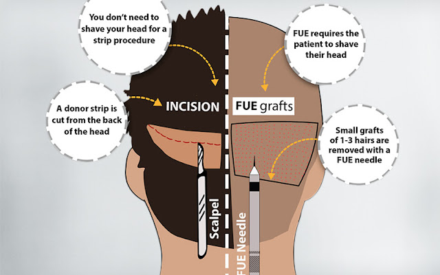 Hair transplant in Jaipur